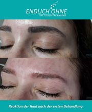 ENDLICH OHNE Tattooentfernung Filiale Leipzig Bild 12