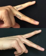 Removery Tattoo Removal & Fading image 2