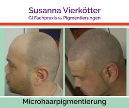 MicrohaarPigmentierung