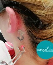 ENDLICH OHNE Tattooentfernung Filiale Kassel Bild 20