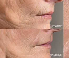 Sara_pavo_cosmetics_essen_Needling_microNeedling.jpg