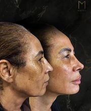 Instituto Marzola | Harmonização Facial imagen 4