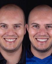 Lente de Contato Dental, Dr. Marcelo Borille imagen 15