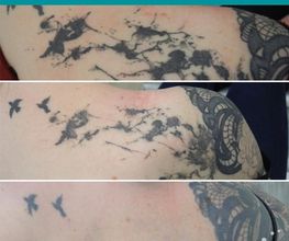 ENDLICH OHNE Tattooentfernung Berlin Bild 3