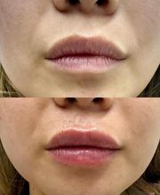 Juvenalia Brío | Botox, Hydrafacial & Ultraformer - Condesa / Roma Norte CDMX imagen 5