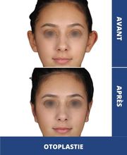 Dr Philippe Legaillard | Chirurgien esthétique Bordeaux | Lifting | Paupières | Rhinoplastie | Augmentation mammaire | Botox image 9