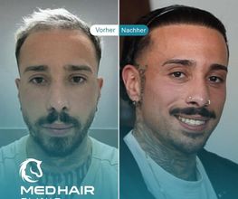 MedHair Clinic | Haartransplantationen in der Türkei Istanbul Bild 5