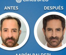 Clinica DrEO - Injerto de Cabello y Barba imagen 10