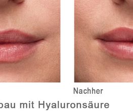 Volumenaufbau mit Hyaloron