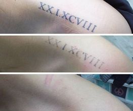 ENDLICH OHNE Tattooentfernung Berlin Bild 7