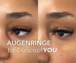 Augenringe unterspritzen mit Hyaluronsäure in Zürich