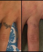 Removery Tattoo Removal & Fading image 2
