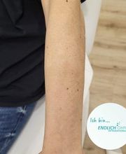 ENDLICH OHNE Tattooentfernung Filiale Kassel Bild 17