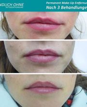 ENDLICH OHNE Tattooentfernung Filiale Leipzig Bild 3