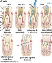 endodoncia-0.jpg