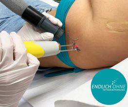 ENDLICH OHNE Tattooentfernung Berlin Bild 4