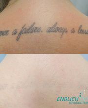 ENDLICH OHNE Tattooentfernung Filiale Dresden/Pirna Bild 4