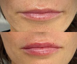 Juvenalia Brío | Botox, Hydrafacial & Ultraformer - Condesa / Roma Norte CDMX imagen 6