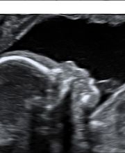 echoscopie 20 weken