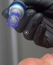 Diodolaser Madrid imagen 13