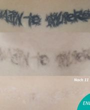 ENDLICH OHNE Tattooentfernung Filiale Wolfenbüttel Bild 20