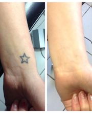 Removery Tattoo Removal & Fading image 4