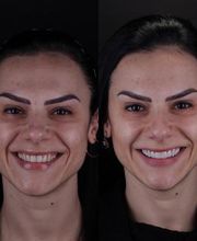 Lente de Contato Dental, Dr. Marcelo Borille imagen 10