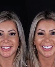 Lente de Contato Dental, Dr. Marcelo Borille imagen 16