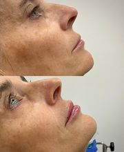 Juvenalia Brío | Botox, Hydrafacial & Ultraformer - Condesa / Roma Norte CDMX imagen 2
