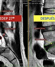 antes-despues-pedep-27.png