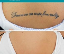 ENDLICH OHNE Tattooentfernung Filiale Dresden/Pirna Bild 12