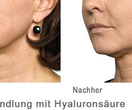 Faltenbehandlung mit Hyaloron