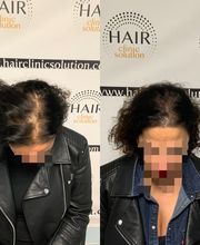 Hair clinic solution spécialiste en micropigmentation du cheveux à Marseille image 6