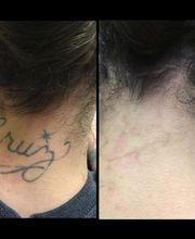 Removery Tattoo Removal & Fading image 7