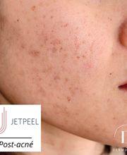 Dermopeel image 6