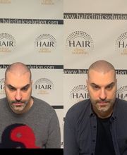 Hair clinic solution spécialiste en micropigmentation du cheveux à Marseille image 9