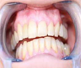 clinica-luz-dental-dra-luz-alvarez-galan-dentadura-02.jpg