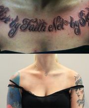 Removery Tattoo Removal & Fading image 5
