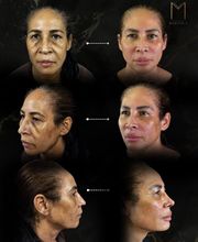 Instituto Marzola | Harmonização Facial imagen 8