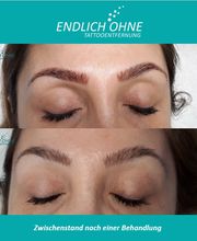 ENDLICH OHNE Tattooentfernung Filiale Leipzig Bild 7