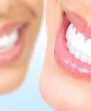 Zahnarztpraxis Dr.med.J.P.Röthlisberger, Bleaching