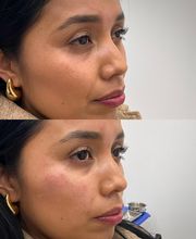 Juvenalia Brío | Botox, Hydrafacial & Ultraformer - Condesa / Roma Norte CDMX imagen 3