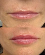 Juvenalia Brío | Botox, Hydrafacial & Ultraformer - Condesa / Roma Norte CDMX imagen 6