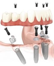 Bodensee Implantatzentrum Dr. Wolfgang Prinz MDSc Zahnarzt/ Implantologie Bild 10
