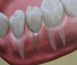 Clínica Implanteoral Milladoiro imagen 13