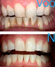 Bij de onder voortanden zit meestal wat meer aanslag. Aanslag ontstaat door o.a. koffie, thee en rode wijn. Het ziet er niet fris uit maar aanslag alleen kan geen kwaad. Natuurlijk is het geen visitekaartje. Durf weer voluit te lachen nadat je bij ons bent geweest!