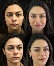 Instituto Marzola | Harmonização Facial imagen 6