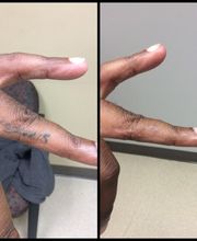 Removery Tattoo Removal & Fading image 1