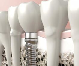 Praxis für Oralchirurgie und Implantologie Zürich Dr. Georg Damerau Bild 6