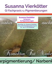 Microhaar Verdichtung 25 Narbenkorrektur